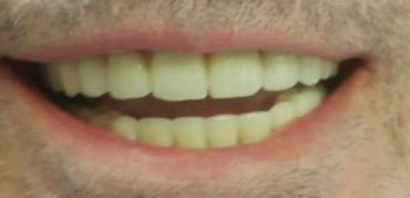 Dentures After 01