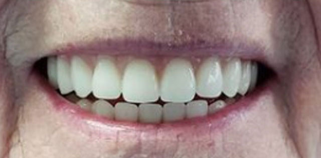 Dentures After 02