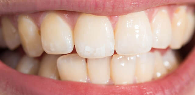 Teeth Whitening Before 01